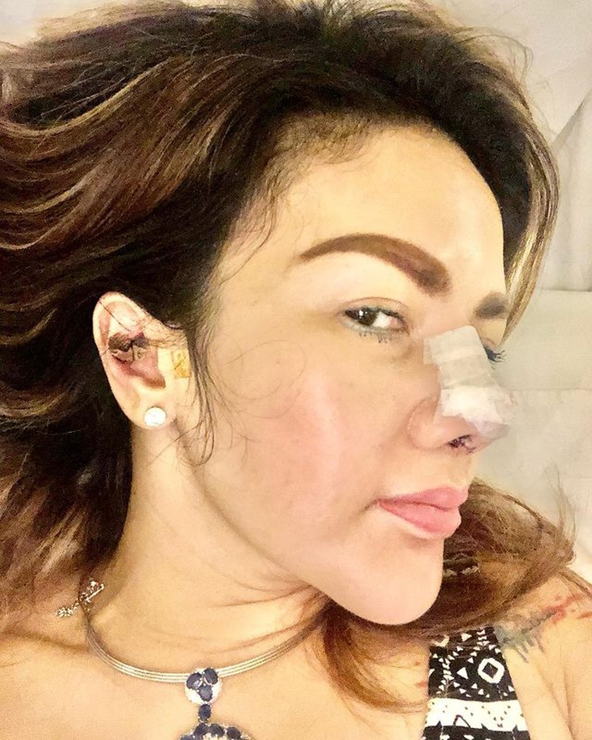 Barbie Kumalasari baru saja melakukan operasi hidung dan habiskan uang sebanyak Rp50 juta&period; Yuk&comma; intip potretnya&excl;