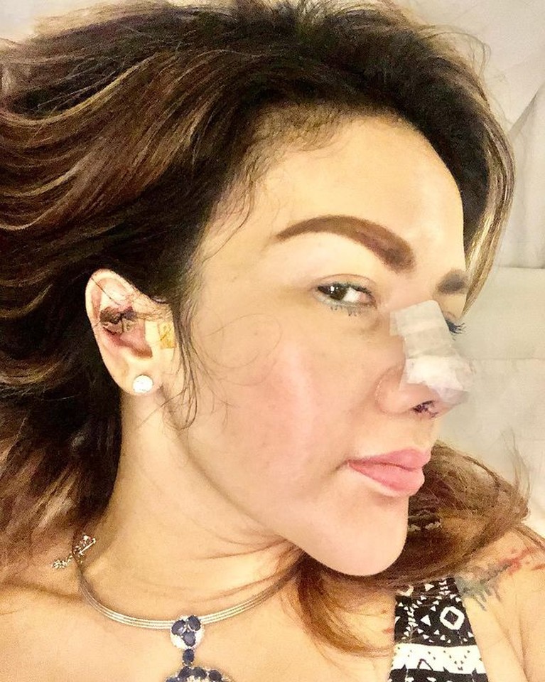 7 Potret Barbie Kumalasari Usai Operasi Hidung Barbie Kumalasari baru saja melakukan operasi hidung dan habiskan uang sebanyak Rp50 juta. Yuk, intip potretnya!