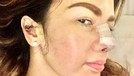Barbie Kumalasari baru saja melakukan operasi hidung dan habiskan uang sebanyak Rp50 juta&period; Yuk&comma; intip potretnya&excl;
