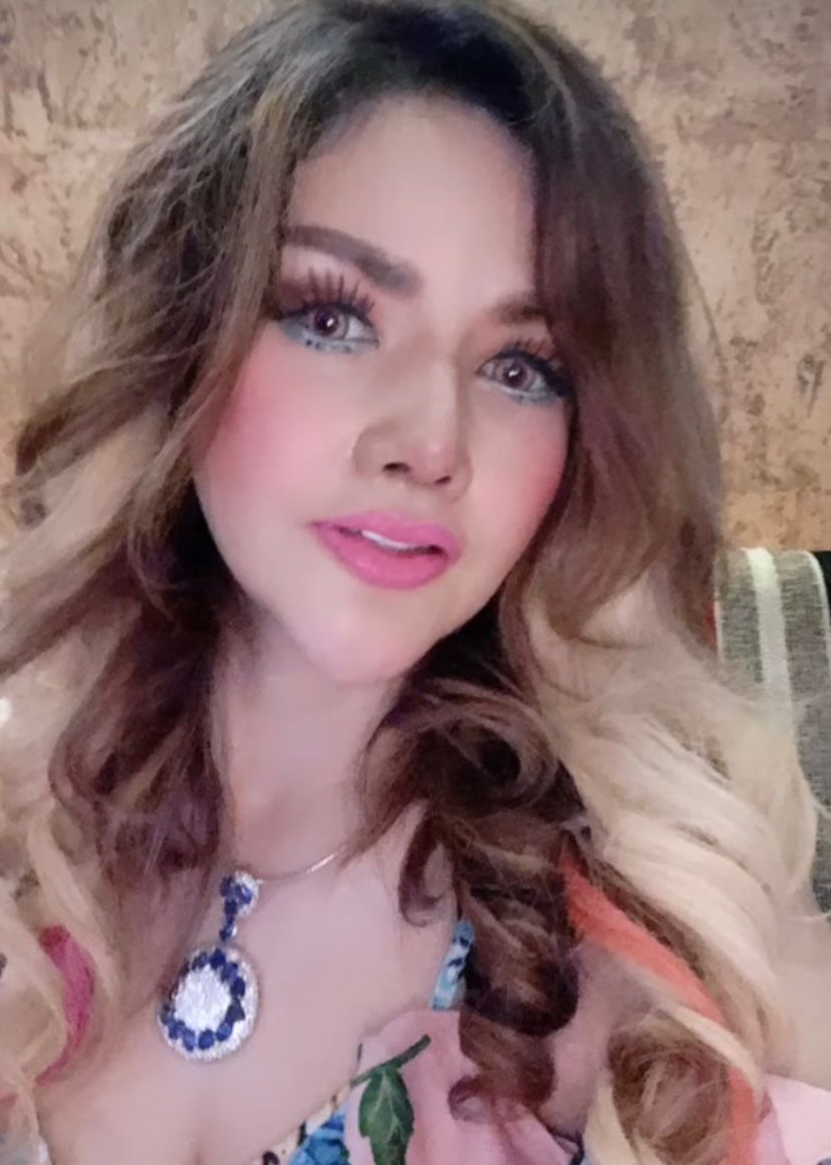 Barbie Kumalasari baru saja melakukan operasi hidung dan habiskan uang sebanyak Rp50 juta&period; Yuk&comma; intip potretnya&excl;