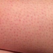 5 Hal yang Picu Timbulnya Strawberry Skin Pada Kaki dan Cara Mengatasinya