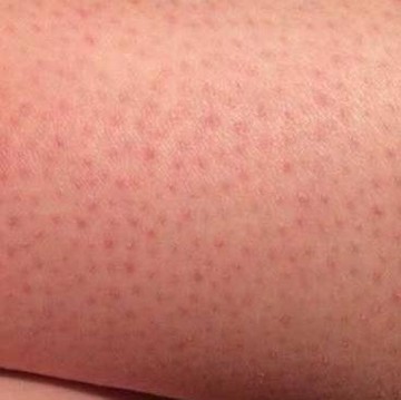 img-title 5 Hal yang Picu Timbulnya Strawberry Skin Pada Kaki dan Cara Mengatasinya