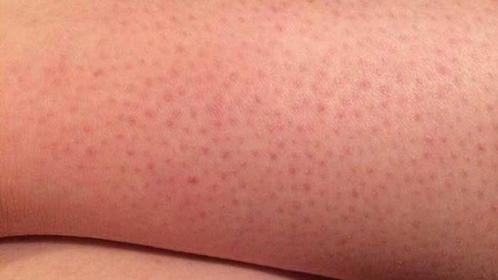 5 Hal yang Picu Timbulnya Strawberry Skin Pada Kaki dan Cara Mengatasinya