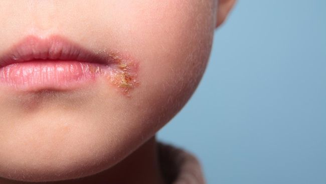 Cara Penularan Herpes pada Balita, Jangan Sembarang Cium