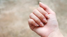8 Sebab Bintik Putih di Kuku, Tak Melulu Karena Covid-19