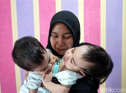 Tolong, Bayi Kembar Siam Asal Sukabumi Butuh Rp 1,6 M untuk Operasi