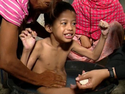 Diikat karena Sering Berguling ke Jalan, Anak Lumpuh Otak Berjuang Sembuh