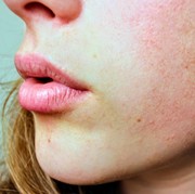 7 Cara Cepat dan Tepat Atasi Sunburn