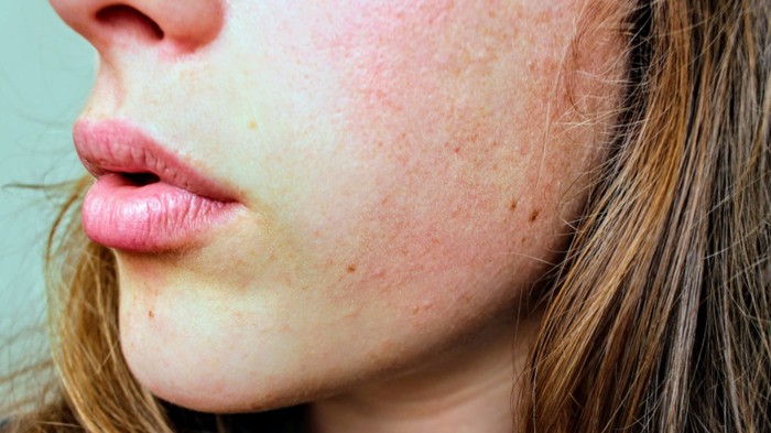 7 Cara Cepat dan Tepat Atasi Sunburn