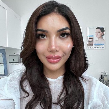 Lucinta Luna Akui Operasi Plastik Ganti Kepala, Nama Millendaru Terseret