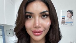 Lucinta Luna Akui Operasi Plastik Ganti Kepala, Nama Millendaru Terseret