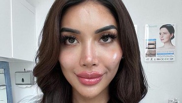 img-title Lucinta Luna Akui Operasi Plastik Ganti Kepala, Nama Millendaru Terseret