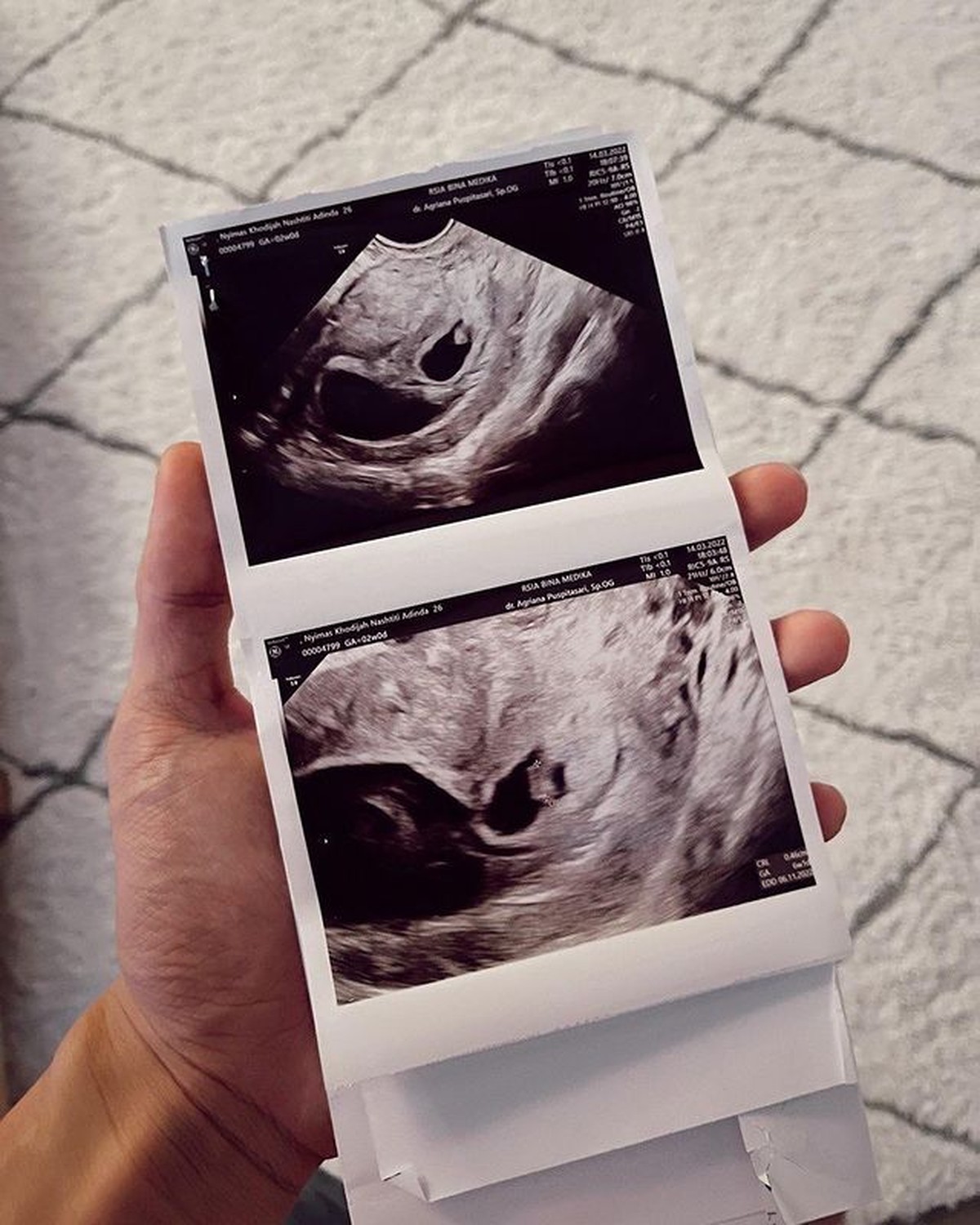 Dinda Hauw keguguran bayi kembar