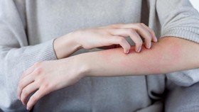 5 Cara Menghilangkan Bekas Luka Bakar
