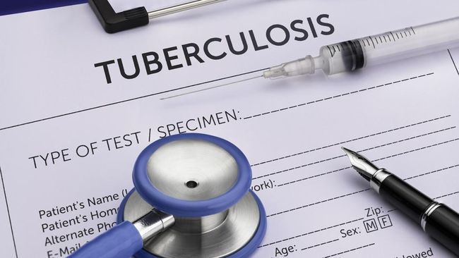 Kasus tuberkulosis (TB) di Indonesia masih begitu tinggi. Penyebabnya banyak pasien yang tidak berobat hingga tuntas.