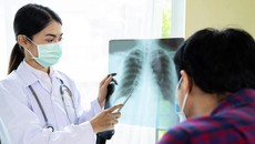 Heru Budi Sebut TBC di Jakarta Capai 60 Ribu Kasus