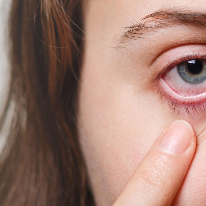 Ilustrasi Iritasi Mata/Freepik/user18526052
