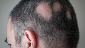 Alopecia Areata, Tak Dapat Diobati Tapi Bisa Dikontrol