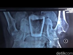 Dokter Duga Pria Jember Masukkan Gelas ke Anus, Tapi Kok Keluarnya Susah?