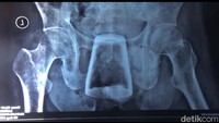 5 Fakta Gelas Kaca di Dalam Tubuh Pria Jember, Begini Penjelasan Dokter