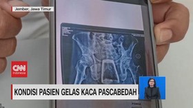VIDEO: Kondisi Pasien Gelas Kaca Pascabedah
