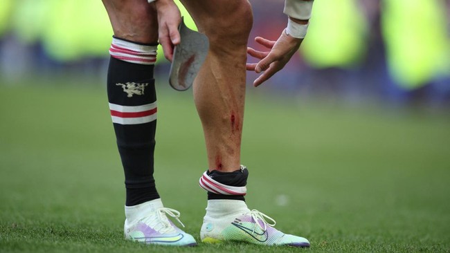 Cristiano Ronaldo mengalami luka di bagian kaki saat Manchester United takluk 0-1 dari Everton pada pekan ke-32 Liga Inggris.