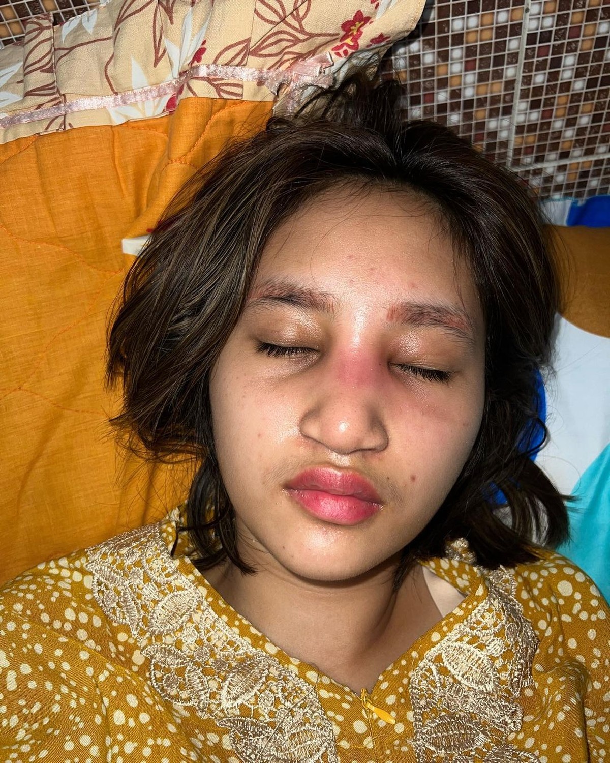 Potret Anak Farida Nurhan Alami Infeksi Implan Hidung Usai Oplas