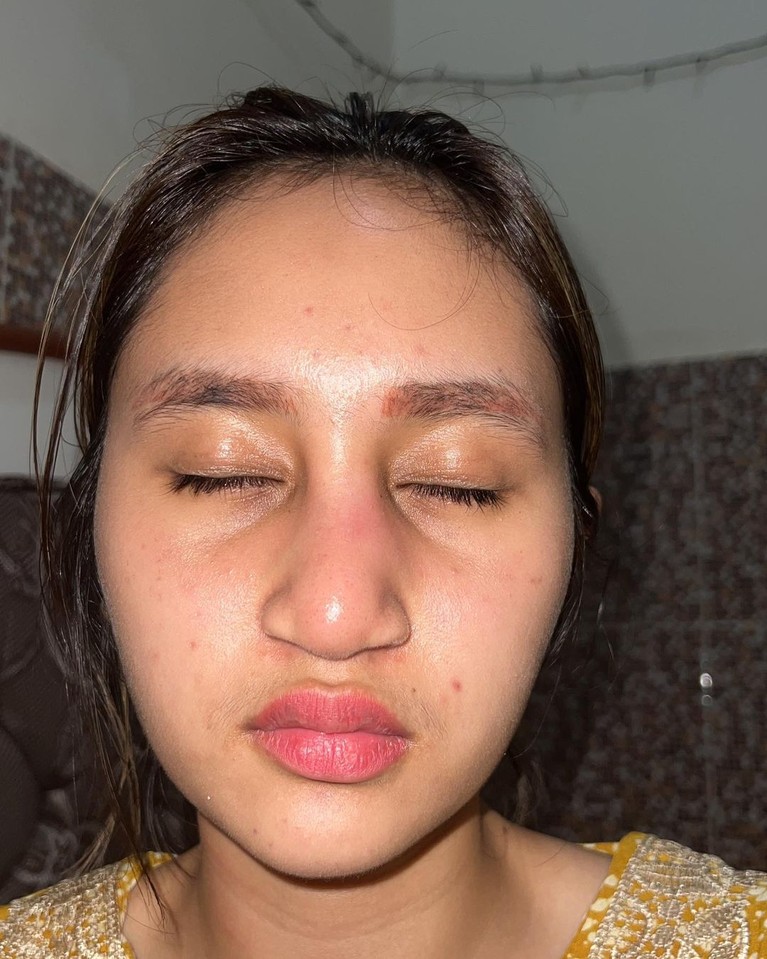 Potret Anak Farida Nurhan Alami Infeksi Implan Hidung Usai Oplas Potret Anak Farida Nurhan Alami Infeksi Implan Hidung Usai Oplas