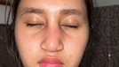 Potret Anak Farida Nurhan Alami Infeksi Implan Hidung Usai Oplas