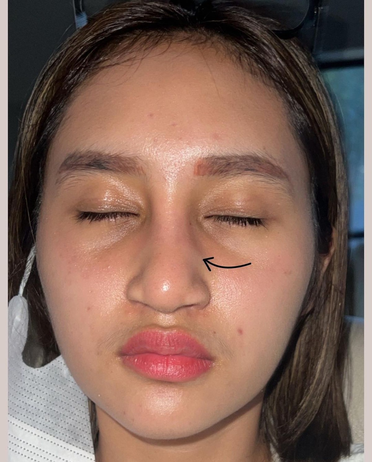 Potret Anak Farida Nurhan Alami Infeksi Implan Hidung Usai Oplas