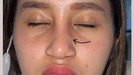 Potret Anak Farida Nurhan Alami Infeksi Implan Hidung Usai Oplas