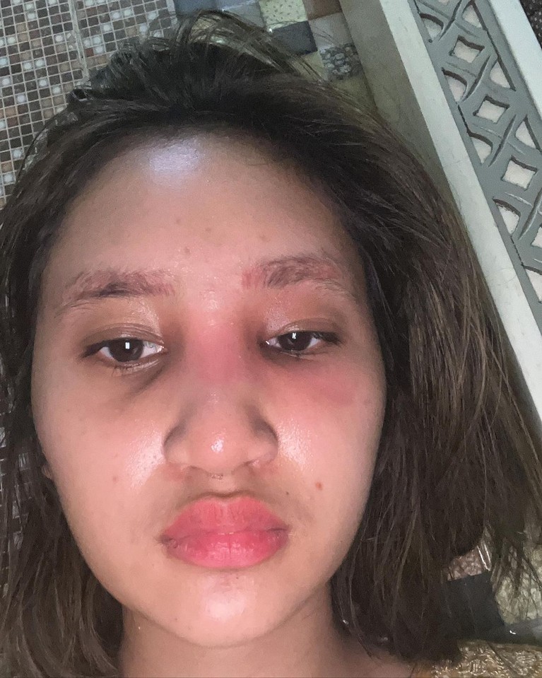 Potret Anak Farida Nurhan Alami Infeksi Implan Hidung Usai Oplas Potret Anak Farida Nurhan Alami Infeksi Implan Hidung Usai Oplas