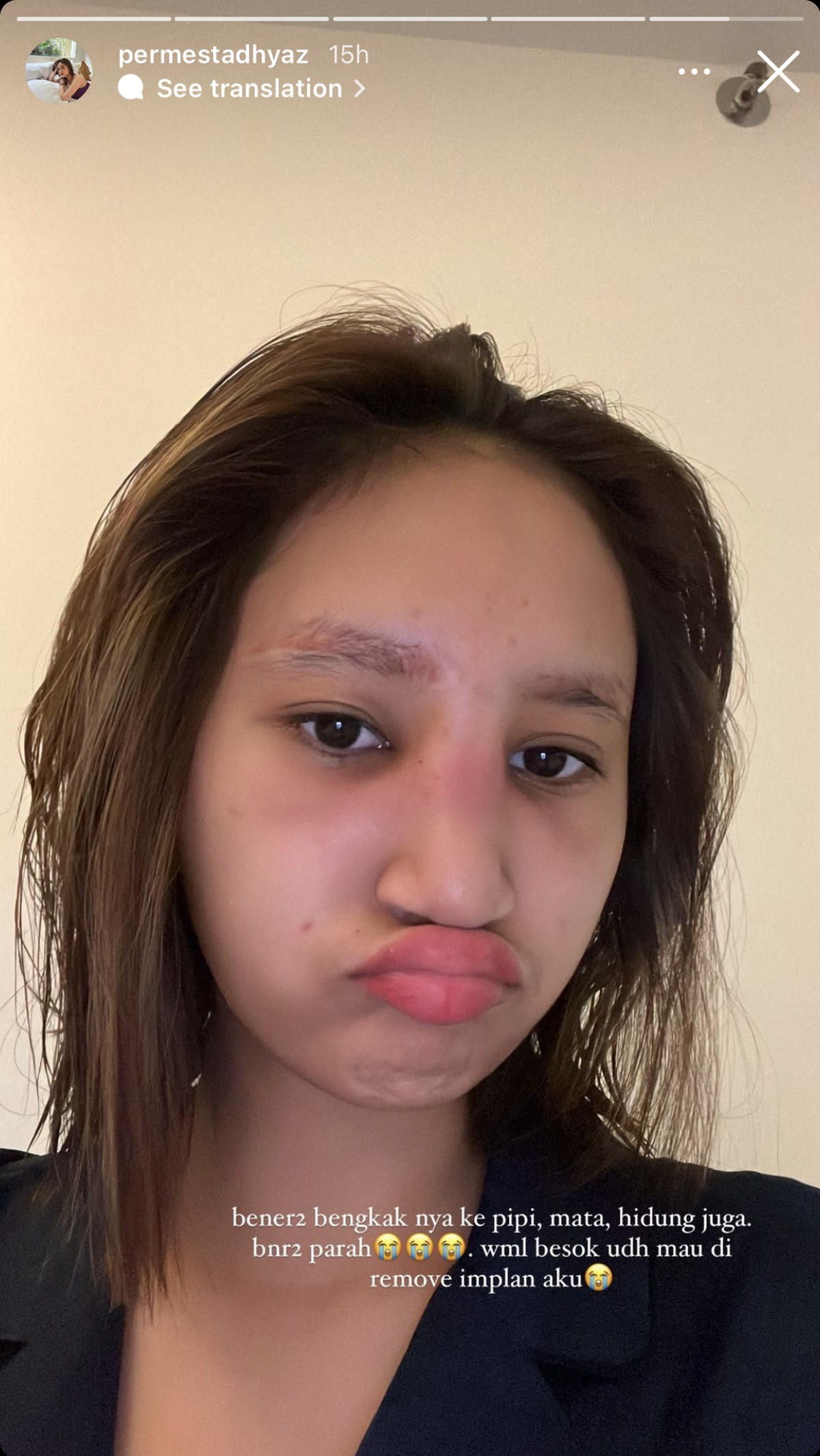Potret Anak Farida Nurhan Alami Infeksi Implan Hidung Usai Oplas