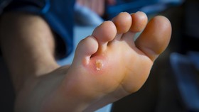 Cara Mudah dan Efektif Menghilangkan Mata Ikan di Kaki