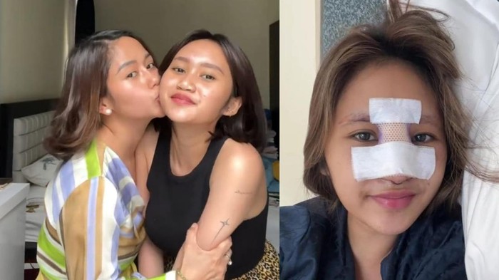Putri Farida Nurhan Alami Infeksi Implan Hidung, Ini Cirinya dan Cara Pilih Dokter Oplas yang Tepat!