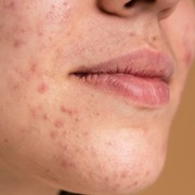 Selain Aloe Vera, 5 Kandungan Alami Ini Juga Dapat Menenangkan Kulit yang Iritasi