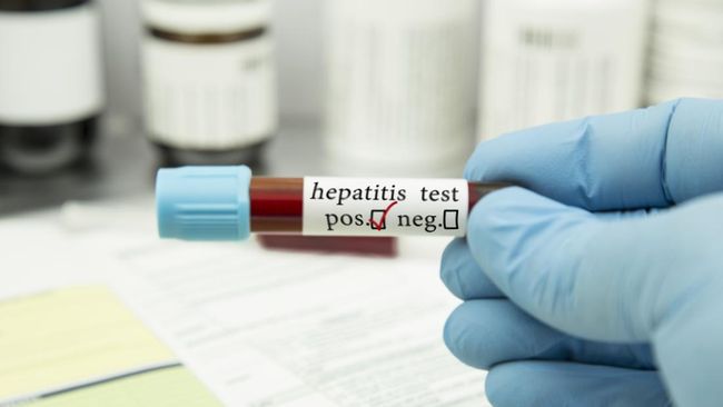 Tes darah HBsAg digunakan untuk mendeteksi hepatitis B. Apa itu HBsAg positif?