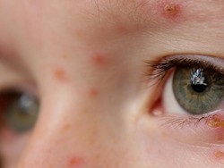 Virus Herpes Terus Mengintai untuk Aktif Kembali dan Menyerang Tubuh