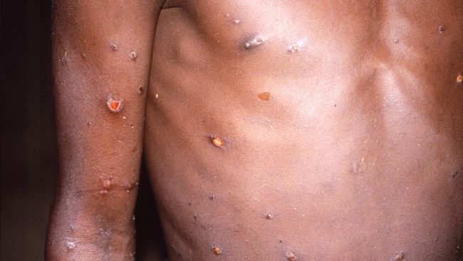 Belgium, Italy, France and Canada “infected” with monkeypox