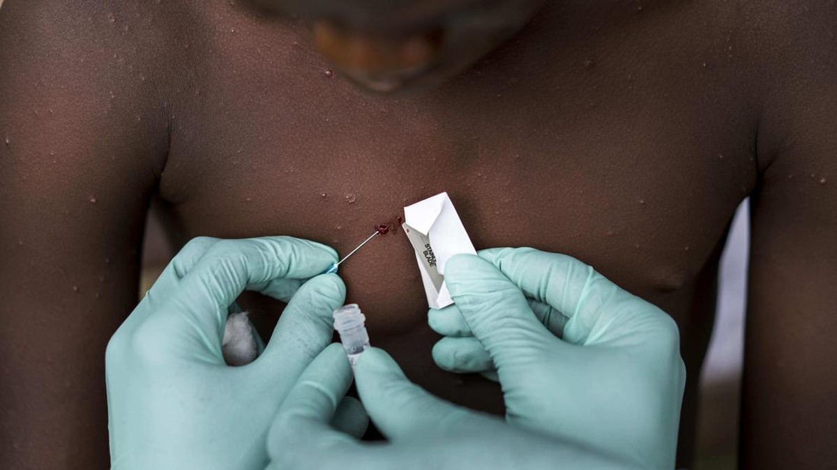 Waspada! Mpox Muncul Lagi, Kini Menyerang Anak-Anak