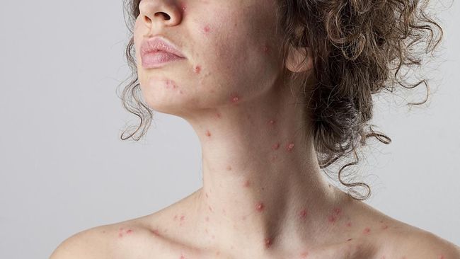 Banyak orang yang terinfeksi HIV bisa mengalami masalah kulit, termasuk diantaranya ruam dan lesi. Apa saja?