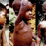 Sudah Menyebar di 12 Negara, Kenali Gejala dan Cara Pencegahan Cacar Monyet