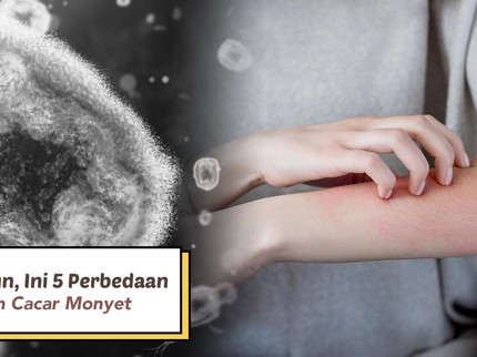 Waspada Bun, Ini 5 Perbedaan Cacar Air dan Cacar Monyet