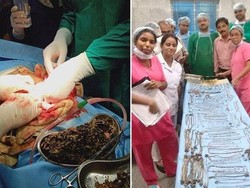 Bukan Makanan, 5 Benda Ekstrem Ini Ditemukan di Dalam Perut Manusia