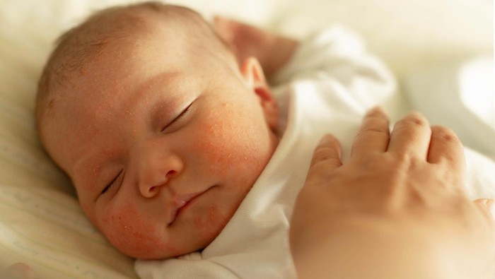 A little baby suffering from skin conditions and red bumps.