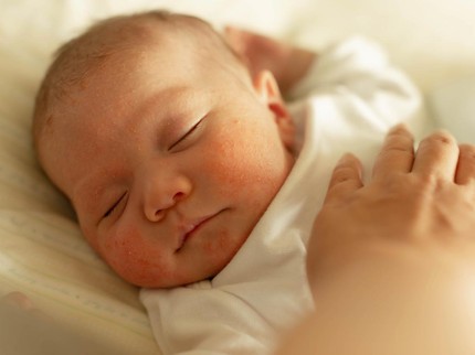 4 Cara Menghilangkan Biang Keringat pada Bayi, Bunda Perlu Tahu