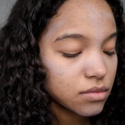 5 Cara Menghilangkan Bruntusan di Wajah, Dijamin Ampuh!