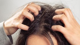 7 Cara Ampuh Menghilangkan Ketombe di Kulit Kepala