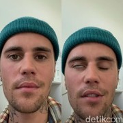 Justin Bieber Terkena Ramsay Hunt Syndrome atau Kelumpuhan pada Wajah, Apa Bedanya dengan Bell's Palsy?