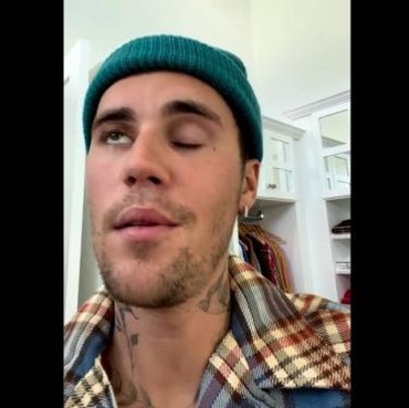 Terserang Virus Langka, Wajah Justin Bieber Lumpuh Sebelah